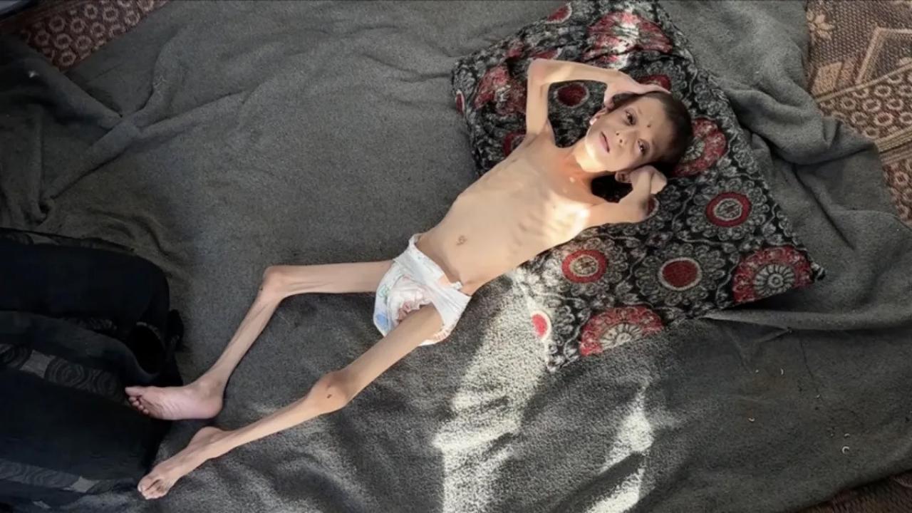 10 yasindaki gazzeli nafiz 4 aylik bebege donustu annesi tasimaya bile korkuyor SXvgJaPl